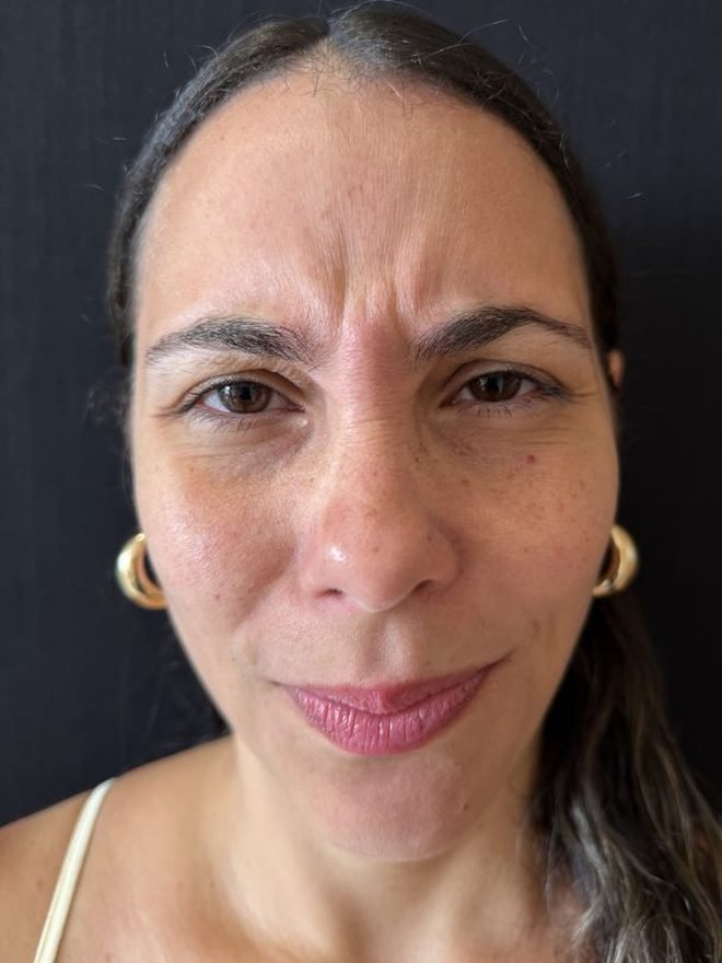 Antes — Botox