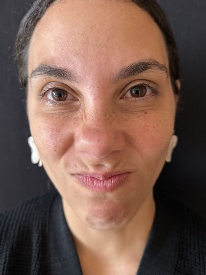 Depois — Botox