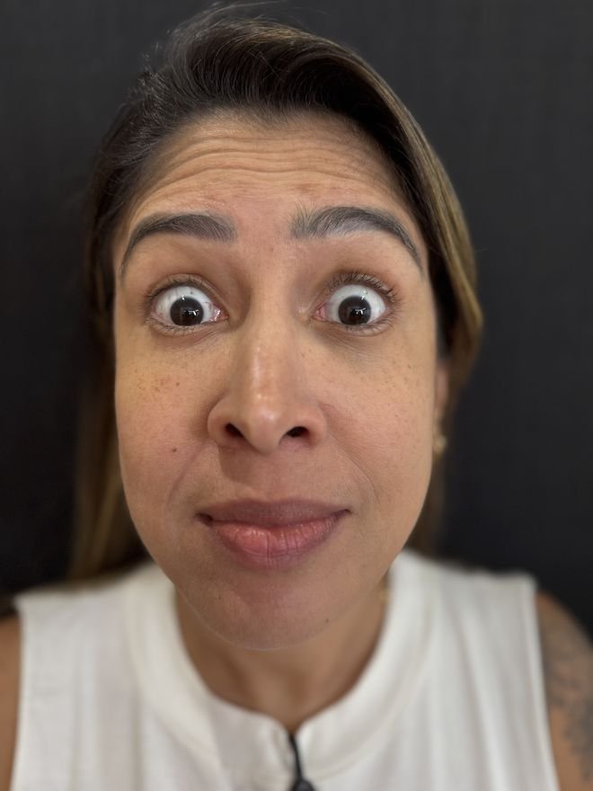 Antes — Botox