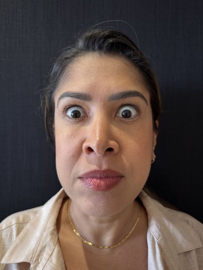 Depois — Botox