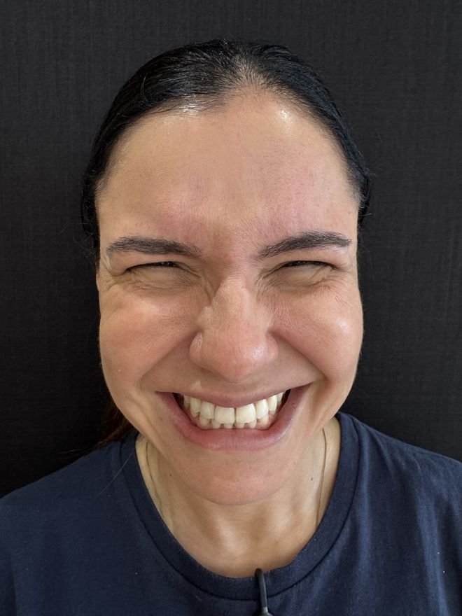 Antes — Botox periocular