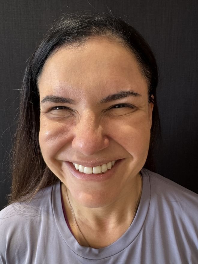Depois — Botox periocular