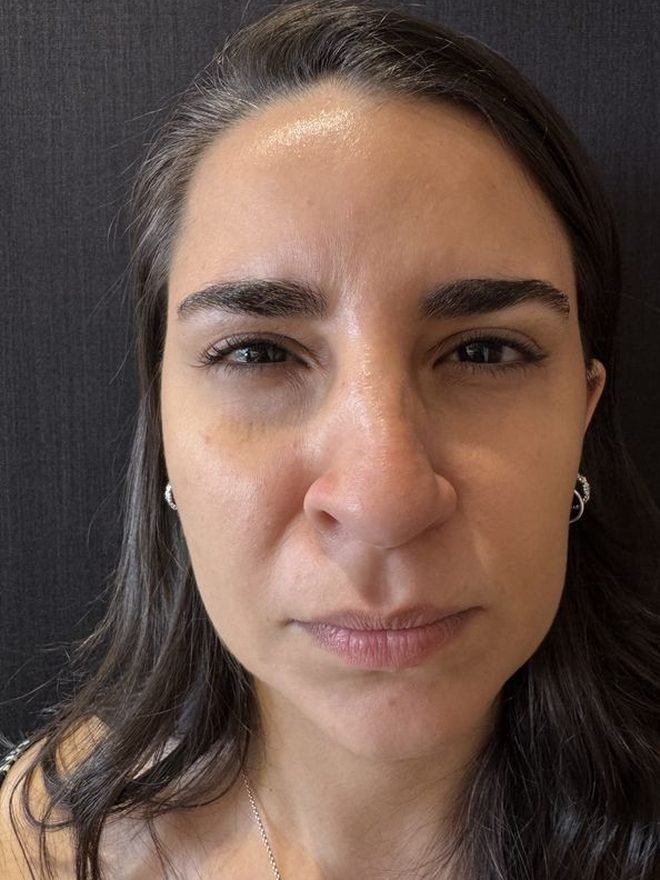 Antes — Bioestimulador de colágeno