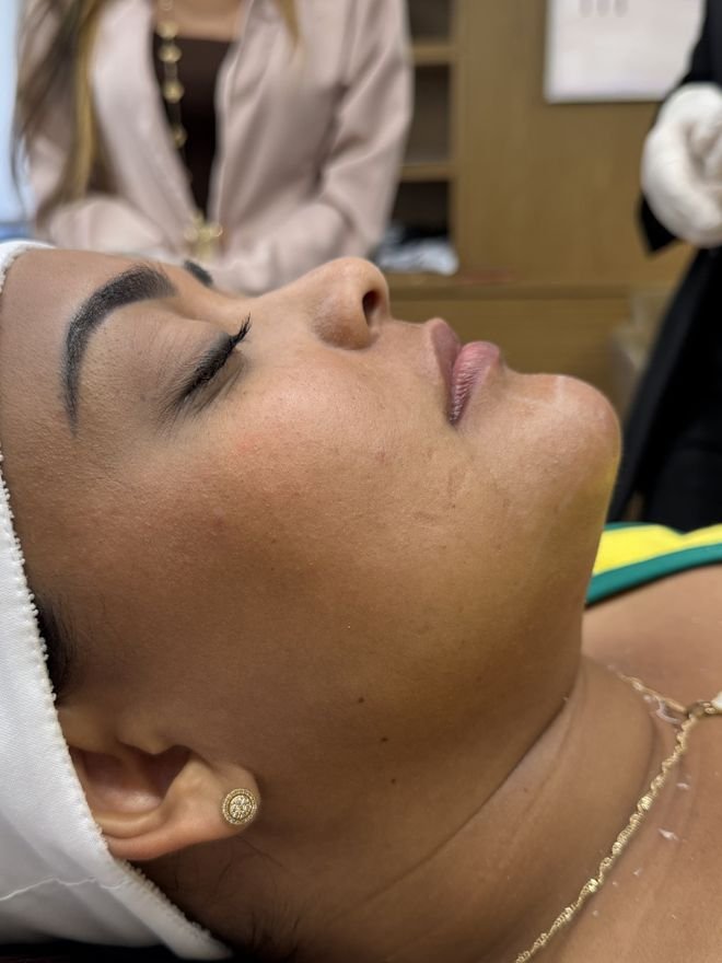 Antes — Preenchimento labial e mento