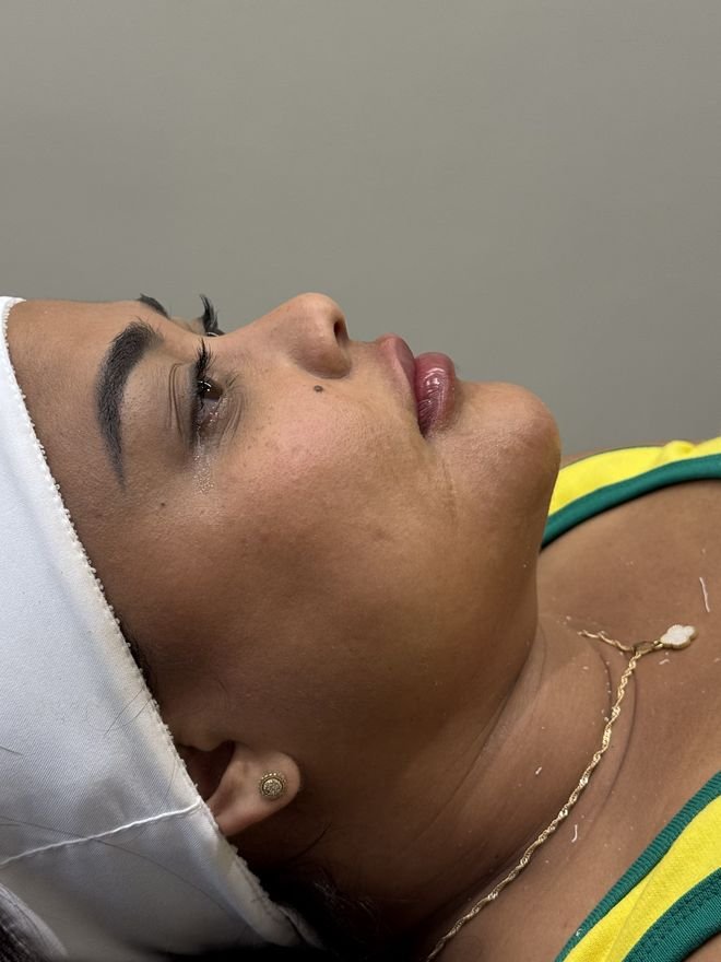 Depois — Preenchimento labial e mento
