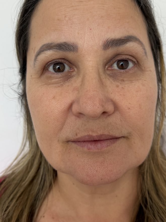 Depois — Sustentação do rosto