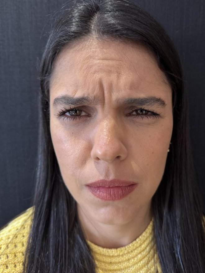 Antes — Botox