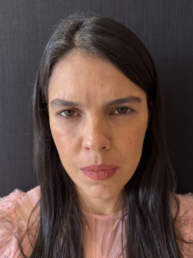 Depois — Botox
