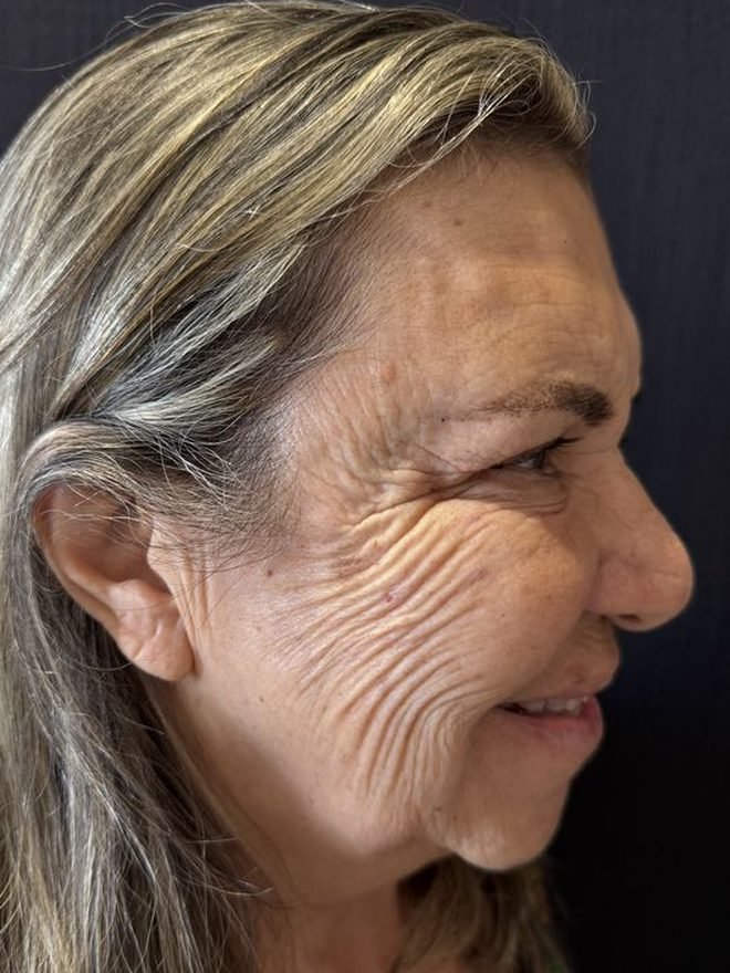 Antes — Protocolo de rejuvenescimento