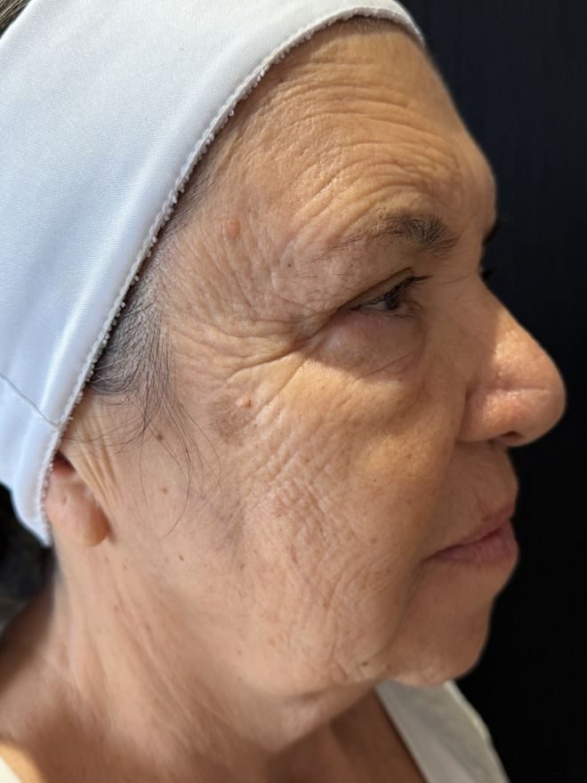 Depois — Protocolo de rejuvenescimento
