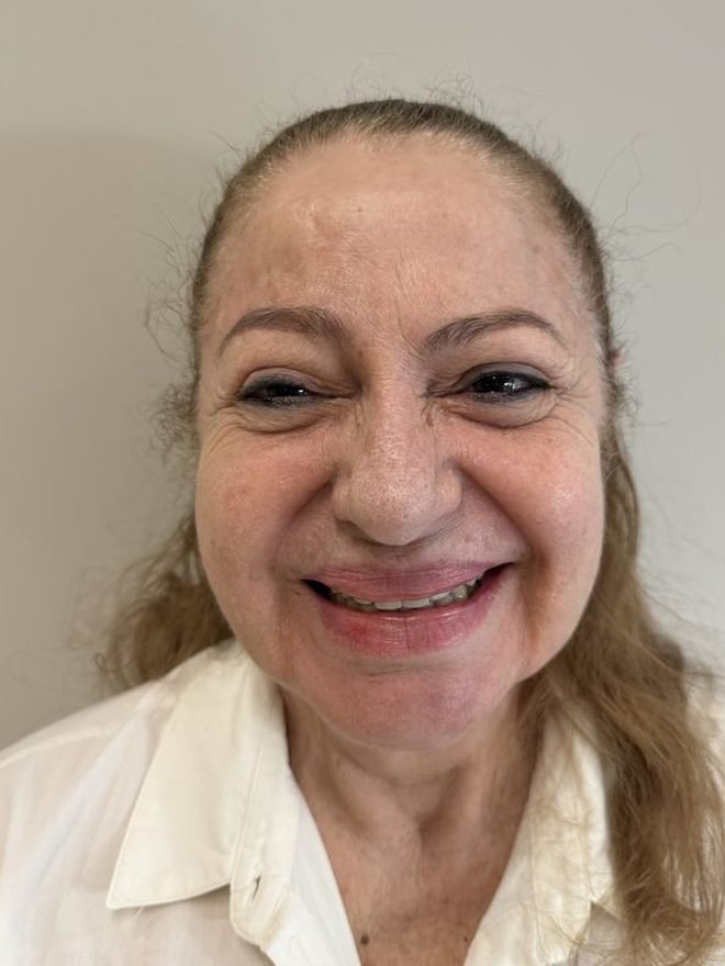 Antes — Preenchimento facial
