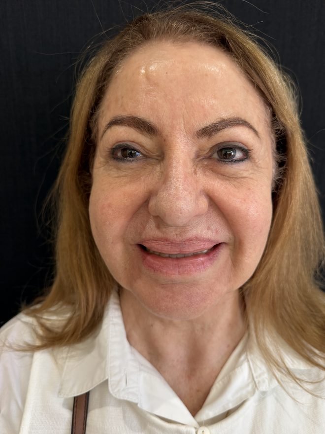 Depois — Preenchimento facial